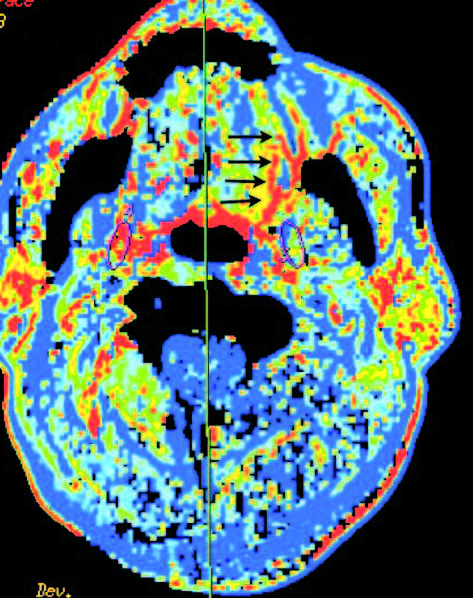 Head and neck squamous cell cancer – the role of computed tomography ...
