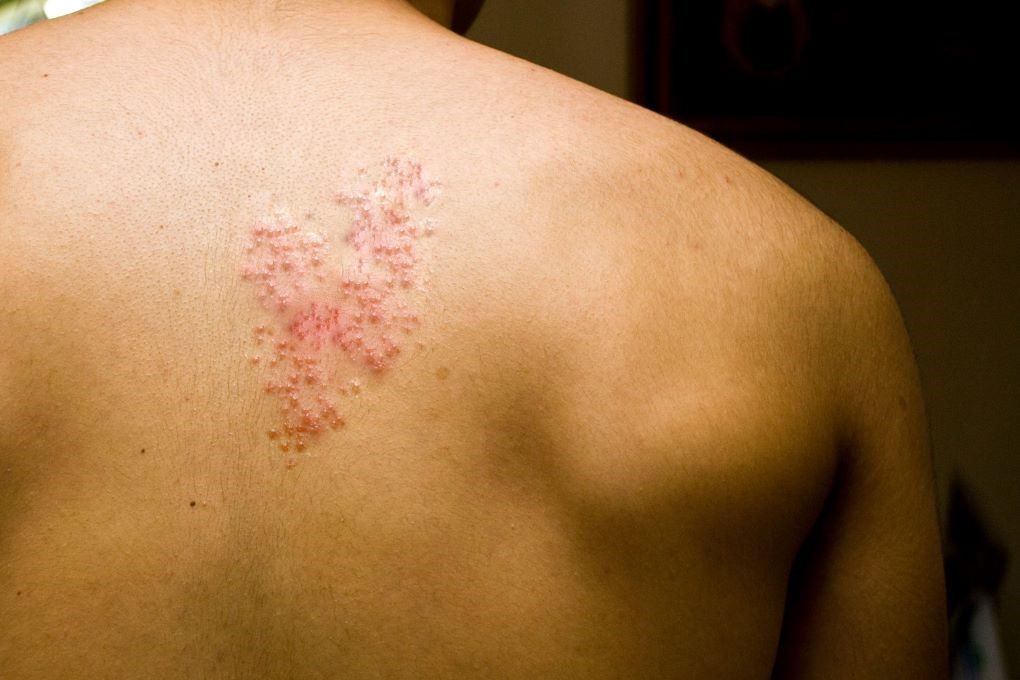 Neuralgia półpaścowa i poważne powikłania półpaśca ►