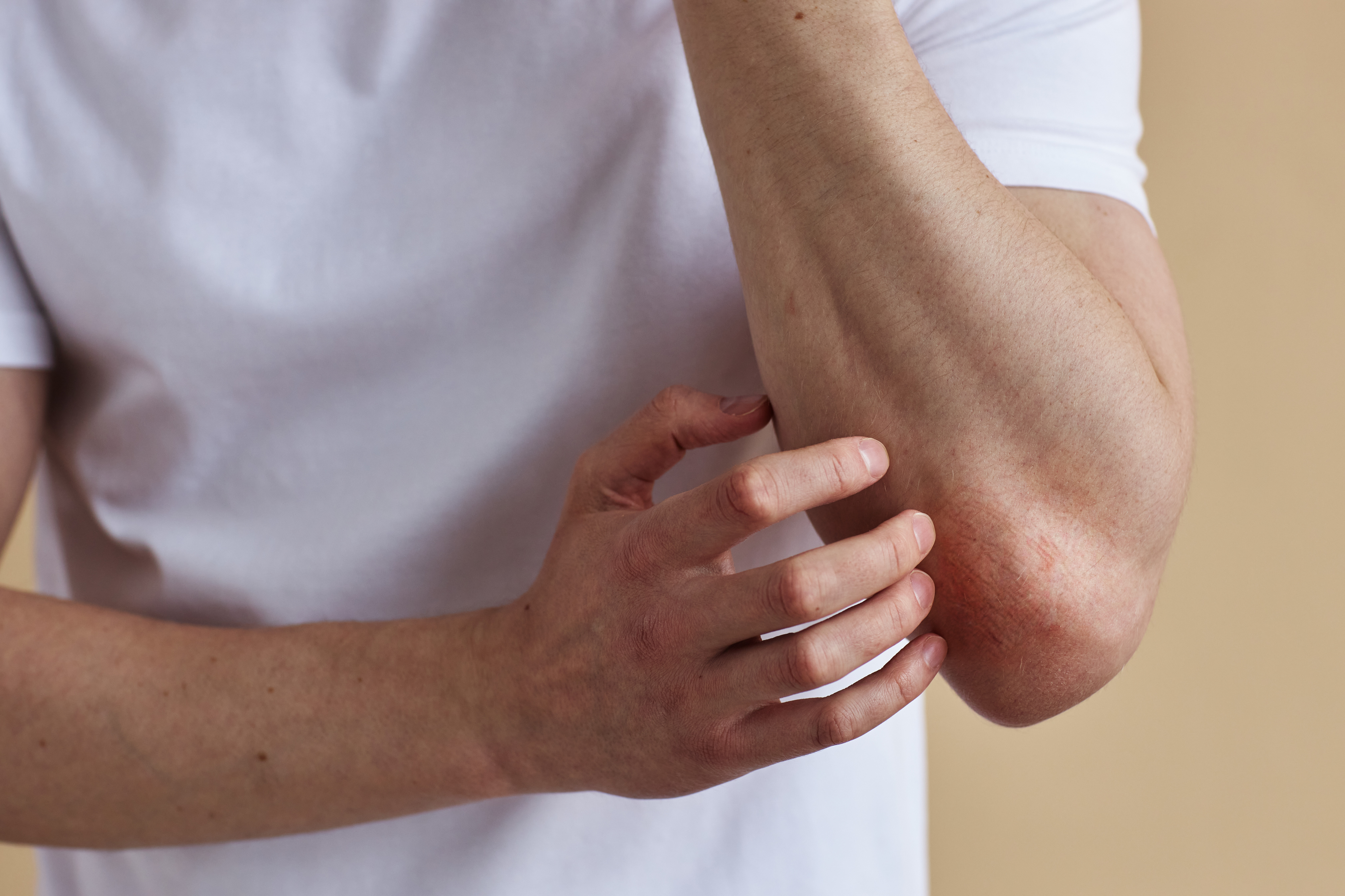 Nemolizumab skuteczny w leczeniu ciężkich postaci atopowego zapalenia skóry