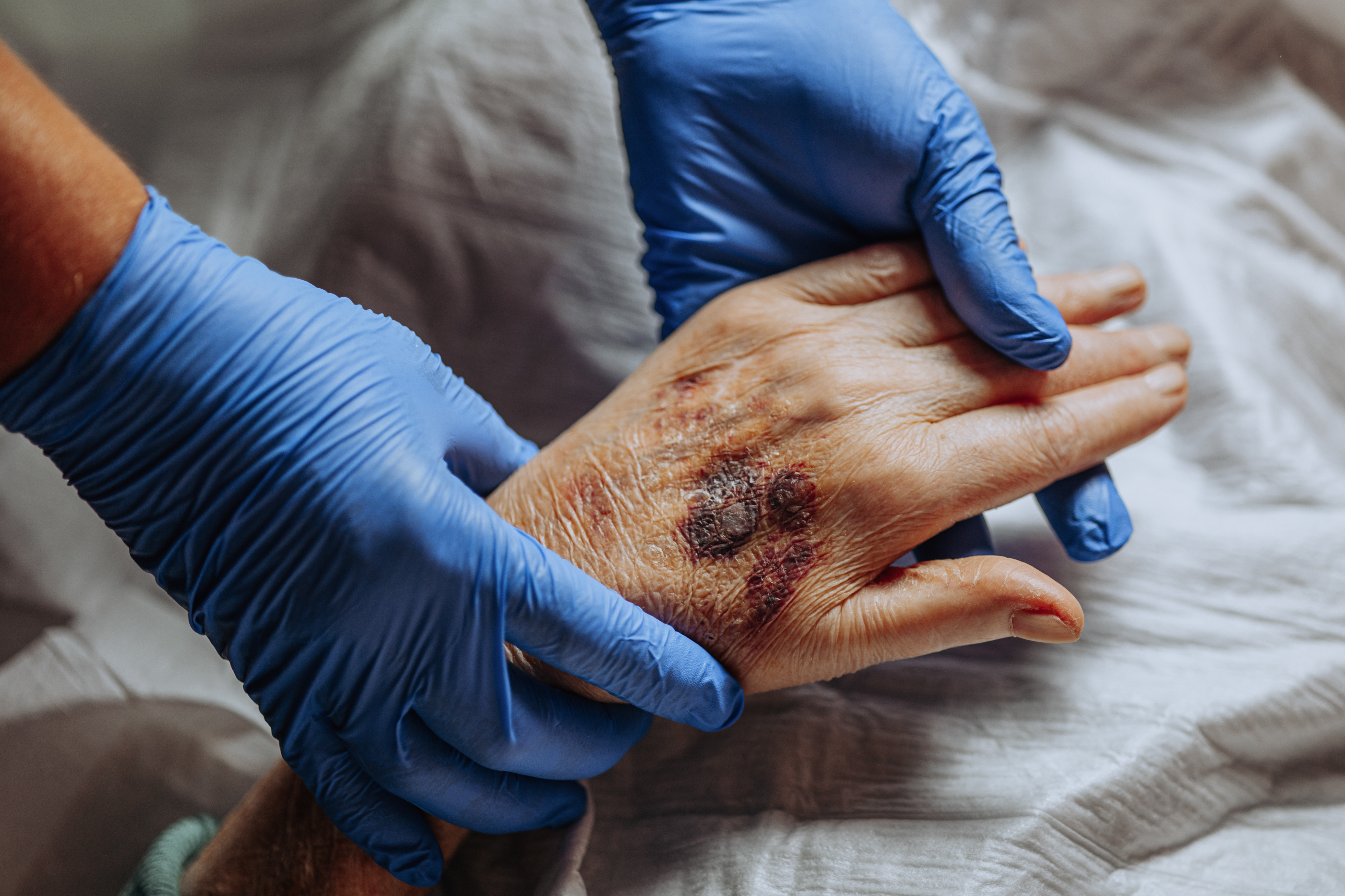Komunikat Ministerstwa Zdrowia w sprawie mpox