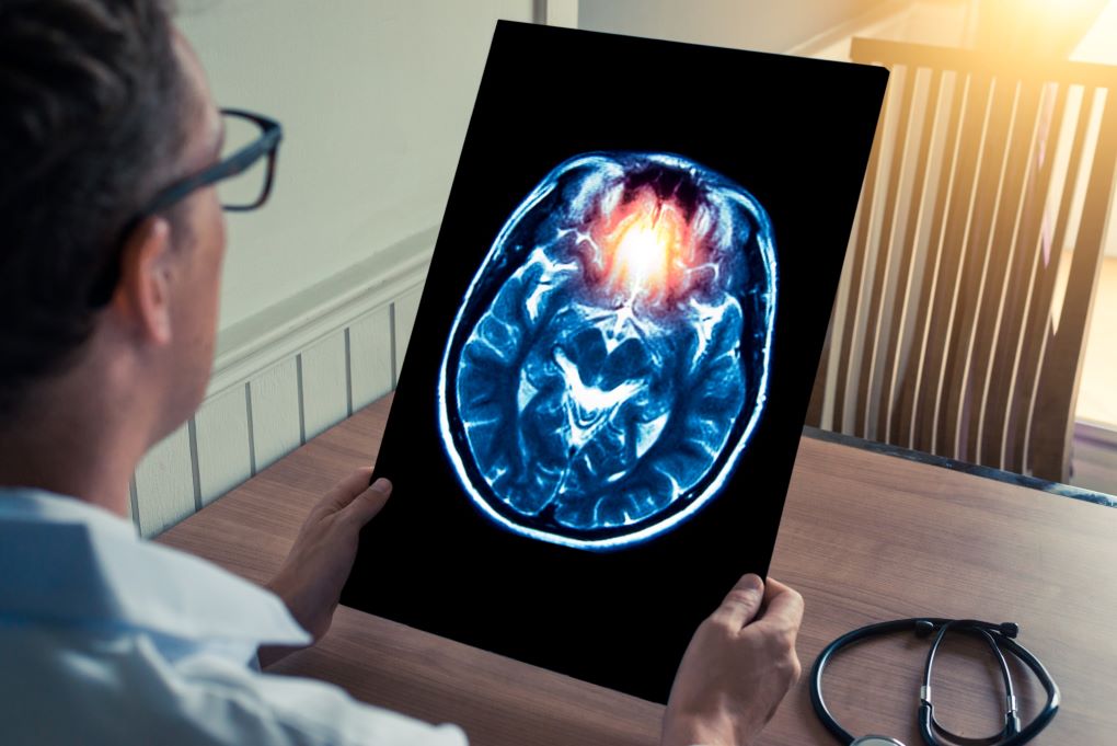 Zapobieganie udarowi – nowe wytyczne w USA