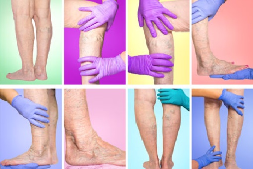 Czy można zatrzymać rozwój przewlekłej choroby żylnej?