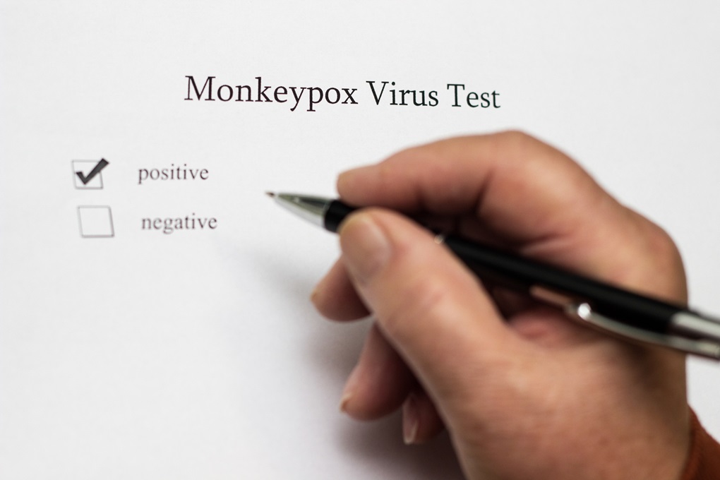 Groźny wariant Mpox w Belgii