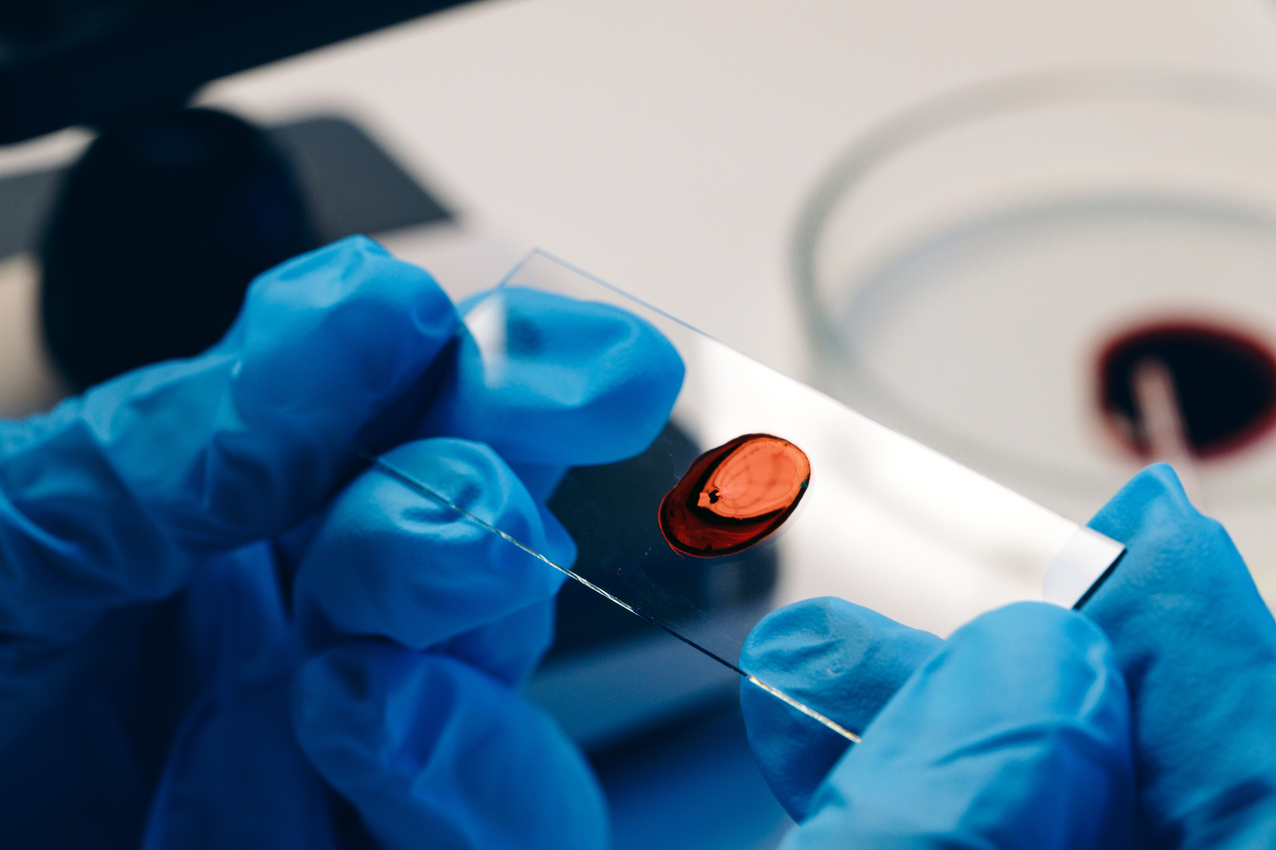 Diagnoza choroby Alzheimera na podstawie jednej kropli krwi?