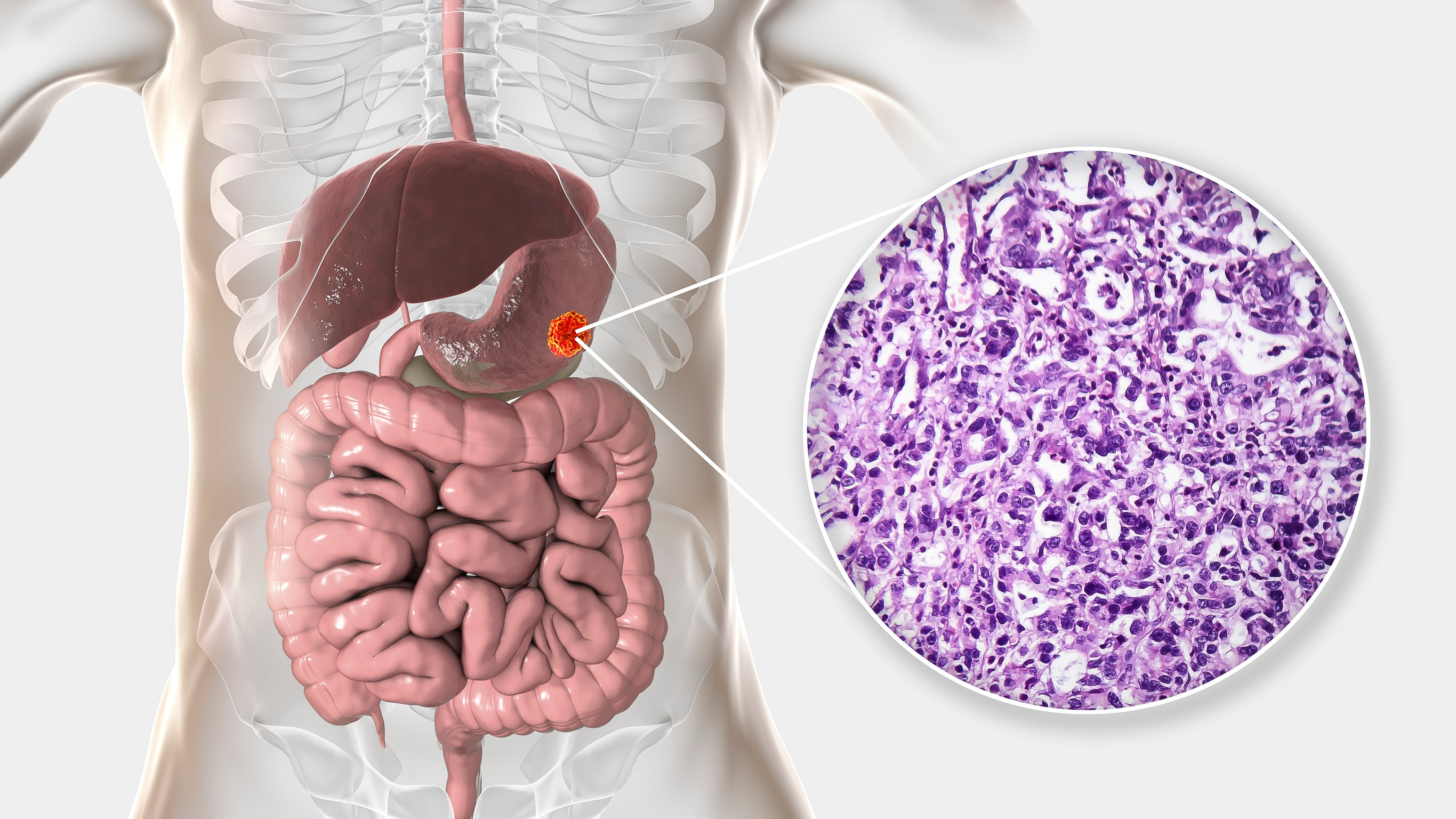 Skuteczność i bezpieczeństwo terapii w leczeniu zaawansowanych GEP-NETs