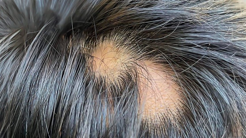 Łysienie plackowate –...